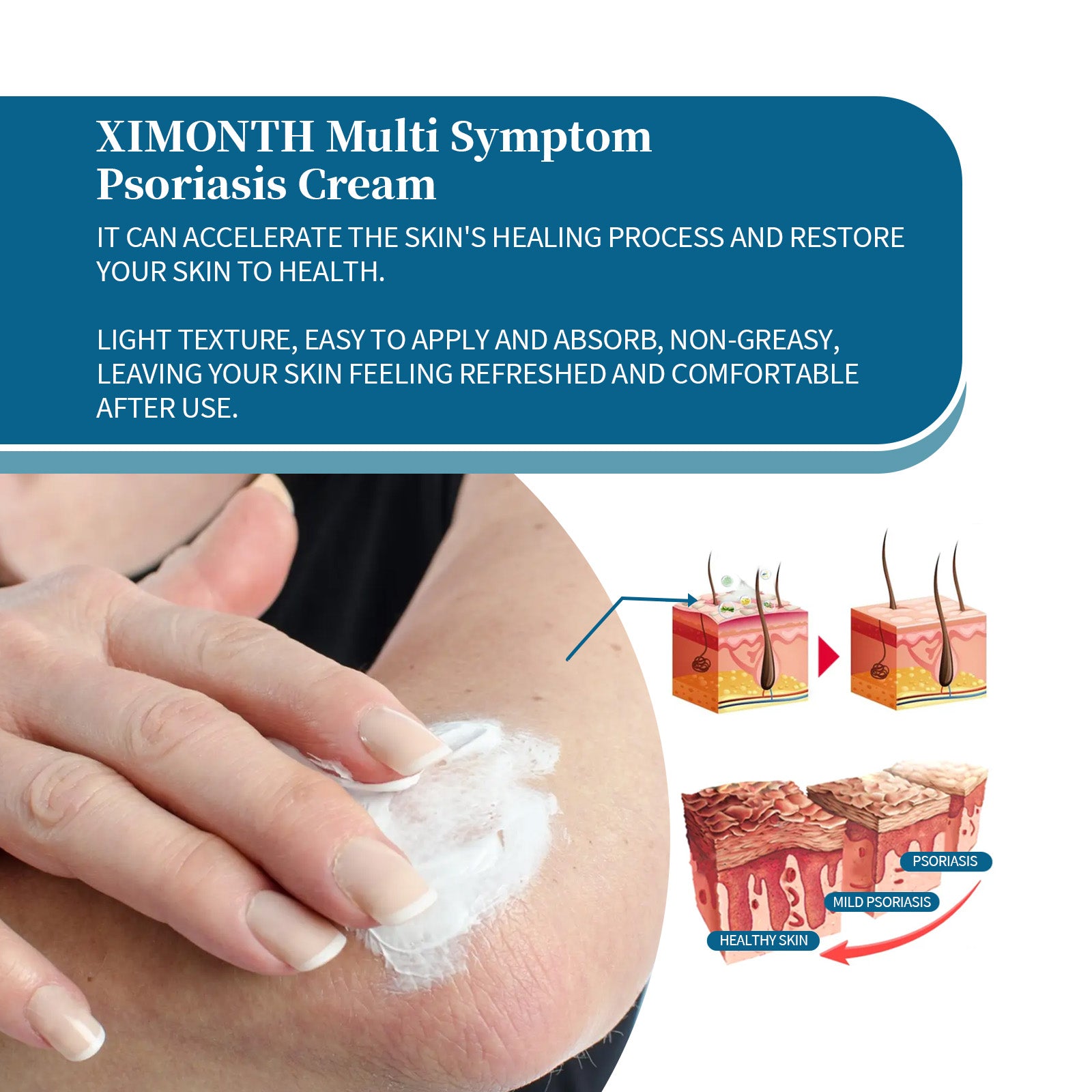 Ximonth Psoriasis Treatment Cream Repair Hand, Foot And Body Moss Redness And Itchy Skin Topical Treatment Cream 5 2f6c68f2-4e90-4646-9138-d2207cb6370e null